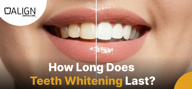 How Long Does Teeth Whitening Last
